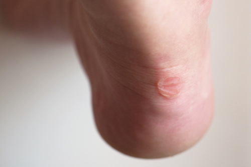 Skavsår på fötterna: orsaker, behandling & förebyggande åtgärder